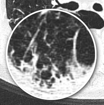 Before treatment