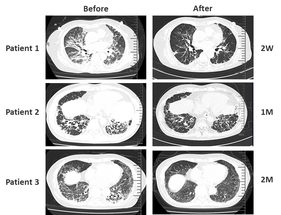 RP-ILD CT comparison